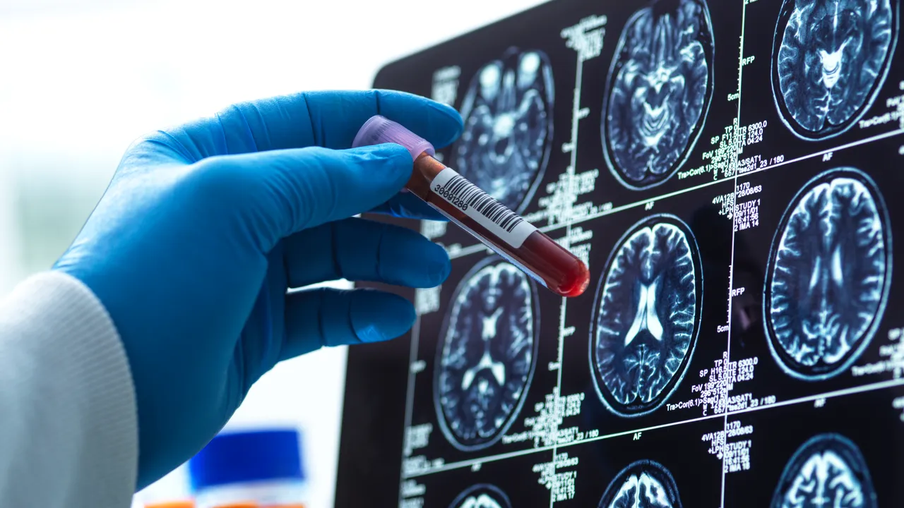 Biomarkkerien yksilöllinen säätö: löytö, joka voi muuttaa Alzheimerin taudin diagnoosin tulevaisuuden.