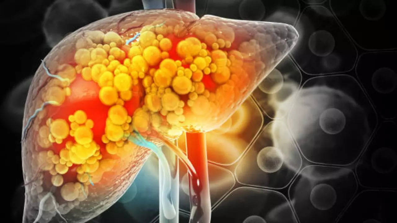 Maksan rasvamaksasairaus: mikä on suositeltava päivittäinen kahvin kulutus tulehduksen vähentämiseksi?