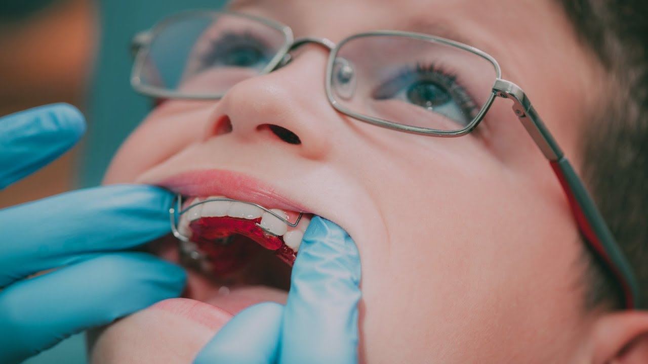 ”Vinojen hampaiden epidemia”: suurin osa lapsista ja nuorista tarvitsee oikomishoitoa.